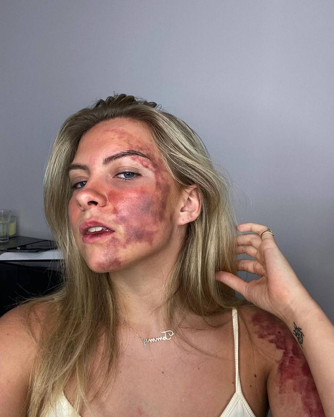 Basit bir uçuk zannetti, korkunç hastalığa yakalandı! Doktorlar bile teşhis koyamadı 6